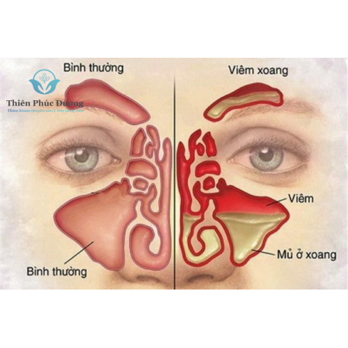 Viêm Xoang Mạn Tính Là Gì? Nguyên Nhân, Triệu Chứng và Cách Phòng Ngừa